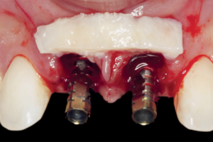 Read more about the article Implantação imediata em região anterior da maxila