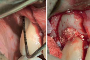 Read more about the article Terapia periodontal regenerativa com biomateriais – relato de caso clínico e follow-up de 30 meses