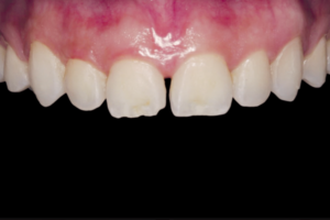 Read more about the article Associação de cirurgia plástica periodontal e resina composta na reabilitação anterior com alta necessidade estética