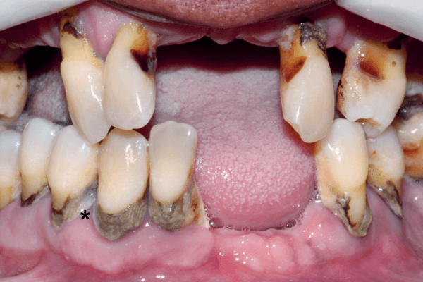 Read more about the article Infecções odontogênicas do complexo maxilofacial: uma preocupação antes e após as reabilitações