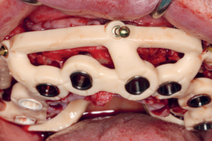 Read more about the article O potencial das ferramentas digitais na Implantodontia guiada e orientada