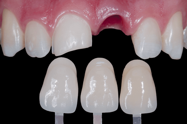 Impacto - Cor e Forma Interna de Dentes Anteriores (Edição