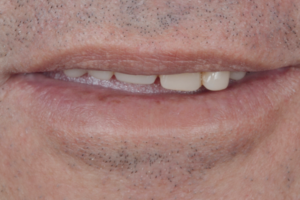 Read more about the article Reabilitação oral com levantamento de seio maxilar e próteses implantossuportadas – relato de caso com três anos de acompanhamento