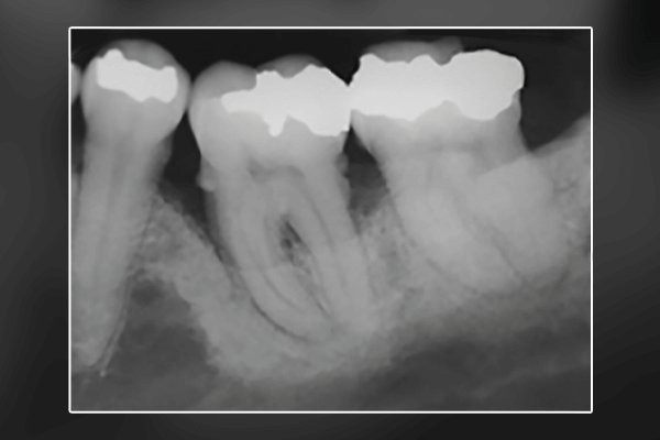 Read more about the article Histórico de periodontite como fator de risco para peri-implantite