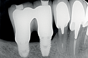 Read more about the article Peri-implantite causada pelo biofilme oculto: diagnóstico e tratamento