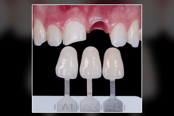 Impacto - Cor e Forma Interna de Dentes Anteriores (Edição