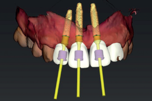 Read more about the article O uso da técnica de cirurgia guiada sem retalho para reabilitação oral com implantes dentários em área estética