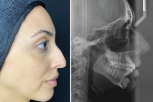 Read more about the article Projeção cirúrgica do mento por meio da técnica CPlus Surgery