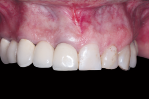 Read more about the article Uso de matriz colágena reticulada suína para substituir o enxerto de tecido conjuntivo em implantes estéticos imediatos