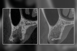 Read more about the article E quando o osso não cicatriza adequadamente após as extrações?