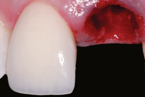 Read more about the article 20 anos atrás na Implantodontia contemporânea: dente extraído e implante colocado na zona estética, mas e as papilas?