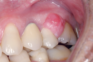 Read more about the article Cirurgia plástica periodontal adjunta à biopsia no manejo tecidual de tumor odontogênico