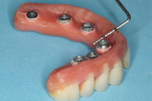 Read more about the article Modificando o perfil de emergência de uma prótese total fixa parafusada sobre implantes