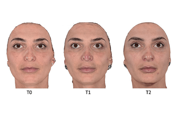 Read more about the article Nova conduta para o tratamento de eritema transitório na ponta nasal após preenchimento com ácido hialurônico