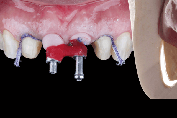Read more about the article Implante imediato adjacente a implantes instalados: manejo tecidual cirúrgico e protético