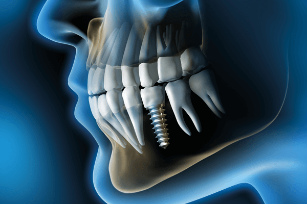 Read more about the article Como implantes dentários antibacterianos podem revolucionar a biossegurança