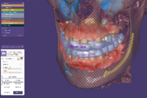 Read more about the article Planejamento: exocad lança nova versão de software para cirurgia guiada