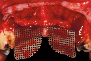 Read more about the article Aumento horizontal do rebordo alveolar com substituto ósseo particulado associado à malha de titânio