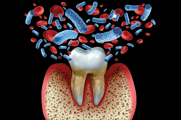 Read more about the article Reflexão sobre as concepções da nova classificação das doenças e condições periodontais: uma breve revisão da literatura