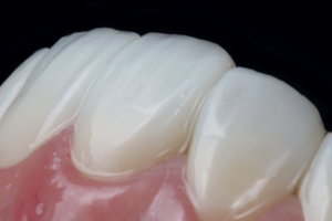 Read more about the article Reabilitação oral estética com resina composta pela técnica direta