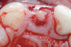 Read more about the article Implante dentário imediato na zona estética associado à técnica de retenção intencional do fragmento radicular: relato de caso clínico com 18 meses de acompanhamento