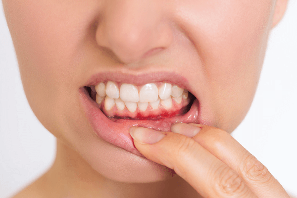 Read more about the article Relação entre a tireoidite de Hashimoto e as doenças periodontais