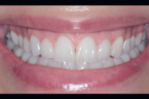 Read more about the article Utilização de biovolume de PMMA 3D no tratamento do sorriso gengival