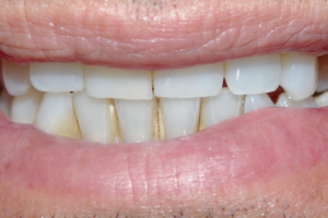 Read more about the article Preservação da arquitetura gengival em região estética com extração e colocação imediata do implante osseointegrável após traumatismo dentário: um ano de acompanhamento com tomografia de feixe cônico