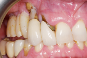 Read more about the article Otimizando a previsibilidade de contorno na região anterior da maxila através da regeneração óssea guiada (enxerto ósseo autógeno, xenogênico, rhBMP-2 e tela de titânio)