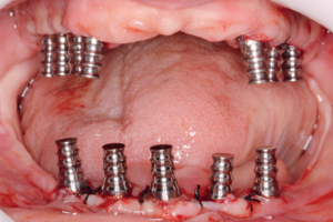 Read more about the article Próteses totais fixas parafusadas sobre implantes: o uso de coroas cerâmicas cimentadas individualmente