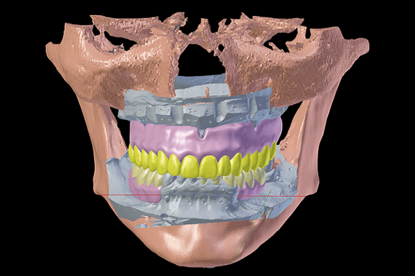 Read more about the article Uso da tecnologia CAD/CAM na Odontologia: do enceramento diagnóstico ao desenho digital integrado. A mudança de um paradigma
