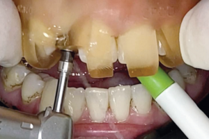 Read more about the article Utilização de alinhadores ortodônticos para obtenção de espaço entre raízes convergentes na região estética e instalação de implante dentário estreito