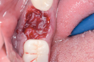 Read more about the article Instalação de implante dentário imediato com regeneração óssea guiada após exodontia atraumática de molar mandibular com fratura radicular