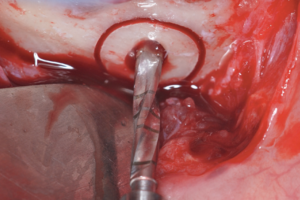 Read more about the article Aumento ósseo vertical com instalação simultânea de implante dentário pela técnica bone ring – acompanhamento clínico de dois anos