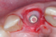 Implante imediato à exodontia em região anterior: preencher ou não o gap com biomaterial?