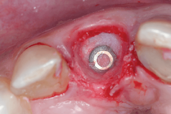 Read more about the article Implante imediato à exodontia em região anterior: preencher ou não o gap com biomaterial?