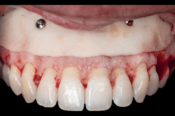 Read more about the article Tratamento do sorriso gengival associando aumento de coroa clínico e reposicionamento labial com cimento ósseo