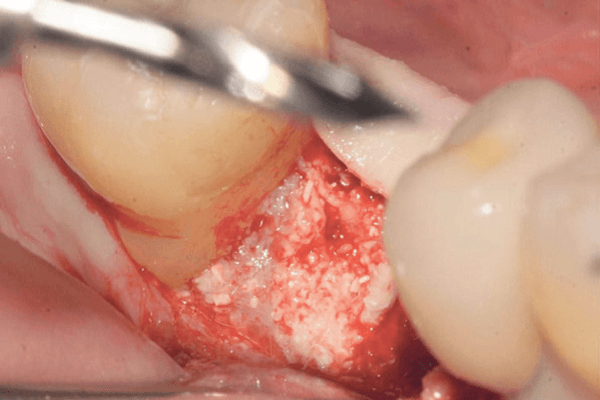Read more about the article Uso de dois tempos cirúrgicos, biomateriais e implante dentário na preservação do alvéolo molar mandibular pós-exodontia por fratura radicular
