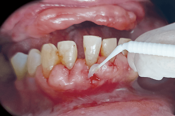 Read more about the article Tratamento periodontal em paciente diabético associando terapia periodontal básica ao oxigênio ativo