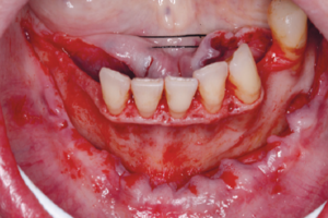 Read more about the article Aumento ósseo horizontal com biomaterial para colocação de implantes osseointegráveis em mandíbula atrófica – três anos de acompanhamento