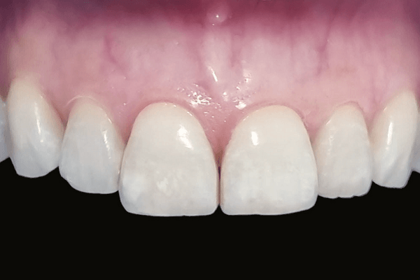 Read more about the article Fenótipo periodontal: classificação e relevância clínica