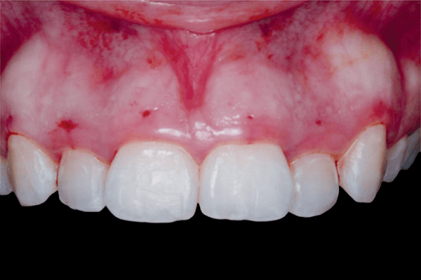 Read more about the article A relevância dos detalhes técnicos no tratamento cirúrgico da erupção passiva e ativa alteradas