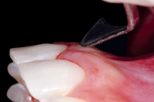 Read more about the article Cirurgia periodontal sem elevação de retalho para tratamento de sorriso gengival