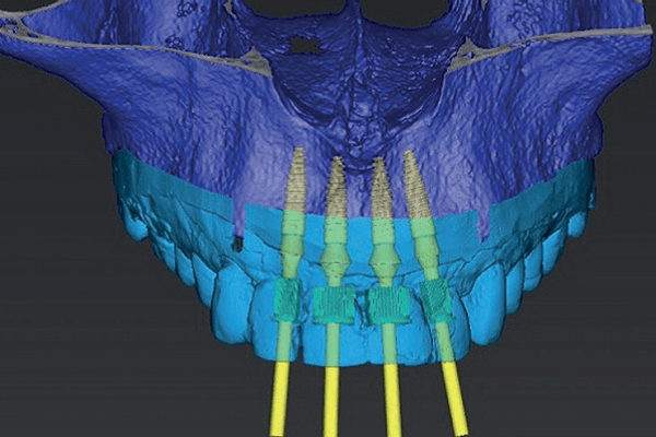 Read more about the article Cirurgia guiada de implantes em área anterior e provisionalização imediata