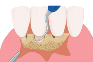 Read more about the article Tratamento periodontal não cirúrgico x cirúrgico