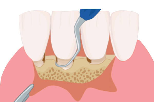 You are currently viewing Tratamento periodontal não cirúrgico x cirúrgico