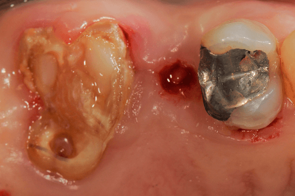 Read more about the article Estratégias para RAPG em segmentos com três dentes ou mais