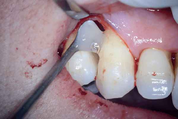 You are currently viewing O uso da magnificação e da microcirurgia na terapia periodontal regenerativa com biomateriais