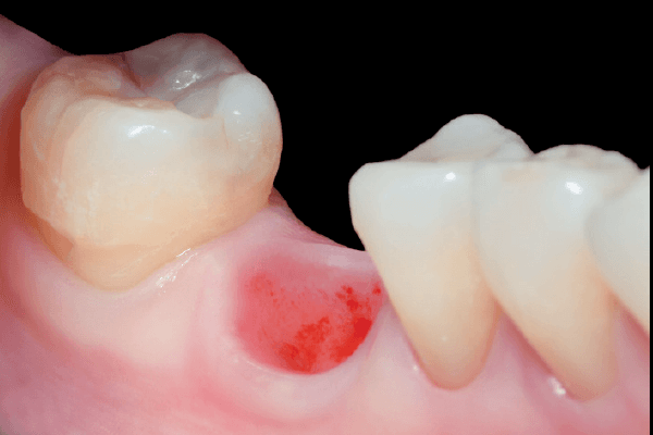 Read more about the article Implantes do tipo cone-morse: posso usar em qualquer situação?