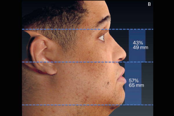 Read more about the article Métricas faciais angulares contribuindo para o diagnóstico da face em perfil: o ângulo nasolabial